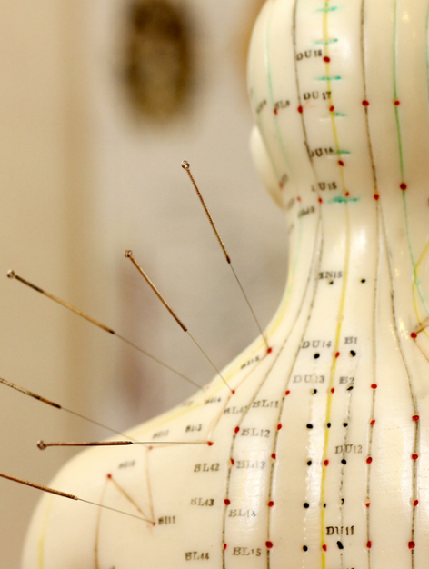 Acupuncture Treatment Img